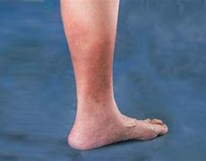 Image result for Skin Darkening Legs