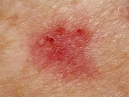 Image result for Basal Cell Carcinoma Cancer Symptoms