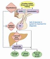 Image result for Gigantism Acromegaly and Dwarfism