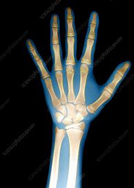 Image result for Child's Hand X-ray