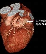 Image result for Thoracoscopic Left Atrial Appendage Clipping