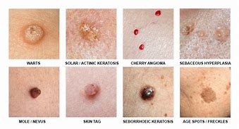 Image result for Skin Lesion Removal