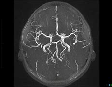 Image result for Brain MRI Angiogram