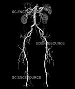 Image result for CT Angiogram Abdomen