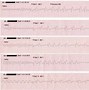 Image result for Ventricular Fibrillation EKG Examples