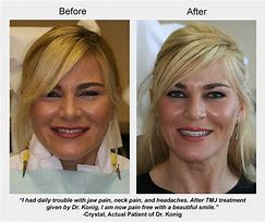 Image result for TMJ Removed