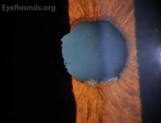 Image result for HLA Gene Uveitis