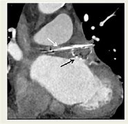 Image result for Thoracoscopic Left Atrial Appendage Clipping