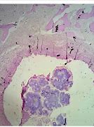 Image result for Actinomycetoma