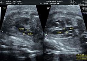 Image result for Anatomical Site of Left Ventricular Outflow Tract