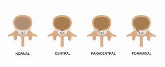 Image result for Spinal DIC Chart