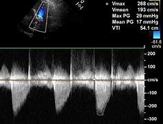 Image result for Aortic Stenosis Doppler