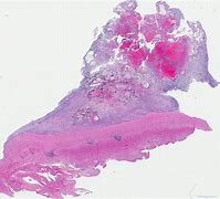 Image result for Cardiac Myxoma