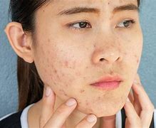 Image result for Itchy Face with Pimples