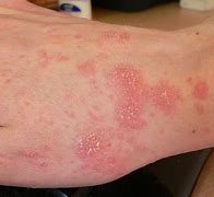 Image result for Mites Under Skin