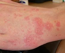 Image result for Mites On Humans Symptoms