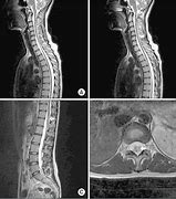 Image result for Abnormal Thoracic Spine MRI