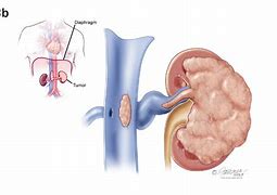 Image result for Kidney Cancer Tumor