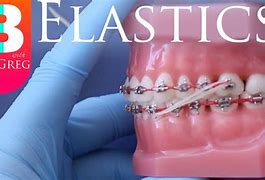 Image result for Ideal Bite Teeth