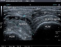 Image result for Sasd Bursitis