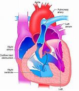 Image result for Right Ventricular Outflow Tract