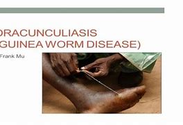 Image result for Dracunculiasis Treatment