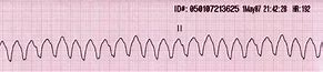 Image result for Polymorphic Wide Complex Tachycardia