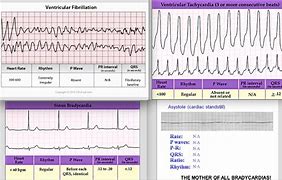 Image result for V-fib