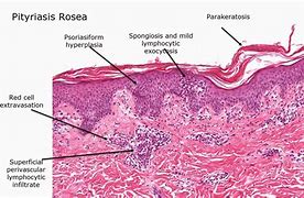 Image result for Psoriatic Pustules