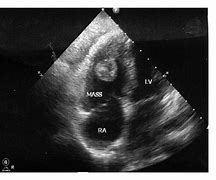 Image result for Right Atrial Thrombus Echocardiogram