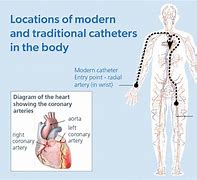 Image result for Coronary Angiography Catheters