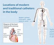 Image result for Coronary Angiography Catheters