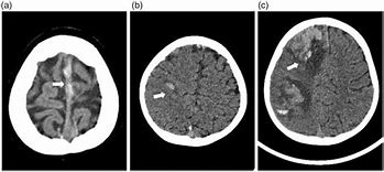 Image result for Orbital Hemorrhage CT