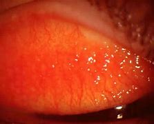 Image result for Tarsal Conjunctiva Papillae