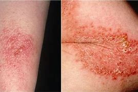 Image result for Poison Ivy Rash African American