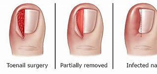 Image result for Pedicure for Ingrown Toenail