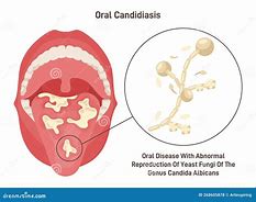 Image result for Candida Throat Infection