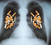 Image result for Lung Cancer On CT