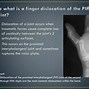 Image result for Dislocated PIP Joint in Pinky Finger