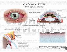 Image result for Corneal Perforation