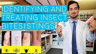 Image result for Treating Insect Bites