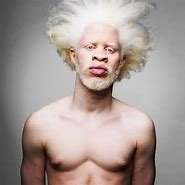 Image result for Child Boy Albino