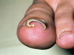 Image result for Pedicure for Ingrown Toenail