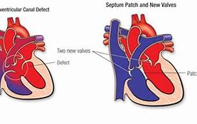 Image result for Tof with Atrioventricular Canal Defect