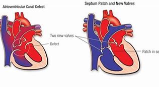 Image result for Complete Atrioventricular Canal Defect