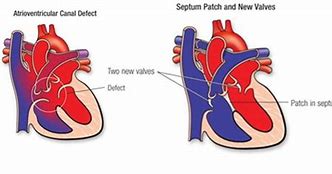 Image result for Atrioventricular Canal Defect Osmosis