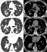 Image result for CT Chest Lung Window