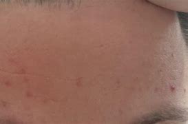 Image result for Pustules On Forehead