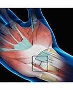 Image result for Wrist Injury