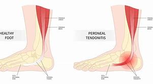 Image result for Tendons Near Lateral Malleolus